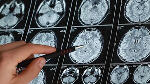 تشخیص زودهنگام آلزایمر با اسکن مغزی جدید